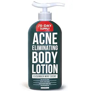 TreeActiv Acne Eliminating Body Lotion 8 fl oz | Clears Body, Back, Butt and Shoulder Acne | Anti-Acne Moisturizer | Prevents Future Breakouts | Cucumber Mint Scent